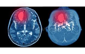 Meno comunemente, l'emorragia intracerebrale può essere data da un aneurisma congenito, una malformazione arterovenosa, altre malformazioni vascolari, un trauma, un aneurisma micotico, un infarto cerebrale (infarto emorragico), un tumore cerebrale primitivo o metastatico, un trattamento anticoagulante eccessivo, una discrasia ematica, una dissezione arteriosa intracranica, una malattia di. 455 Emorragia Cerebrale Foto Foto Stock Gratis E Royalty Free Da Dreamstime