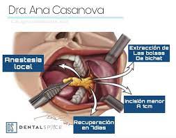 La bichectomía o cirugía de extracción de las bolas de bichat, es un procedimiento, como así lo indica, que consiste en la extracción de las bolas de bichat unas glándulas de tejido graso que se encuentran en las mejillas. Que Es La Bichectomia Cuanto Cuesta Y Quienes La Tienen Mujer Mexico