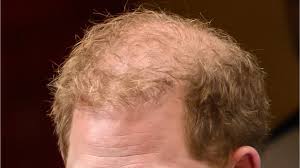 Spare hair': Prince Harry is 'balding ...