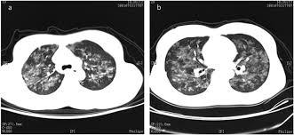 Nonsmokers who are exposed to secondhand smoke at home or at that is why lung cancer screening is recommended only for adults who are at high risk for developing the disease because of their smoking history and age. Predominant Diffuse Ground Glass Opacity In Both Lung Fields A Case Of Sarcoidosis With Atypical Ct Findings Abstract Europe Pmc