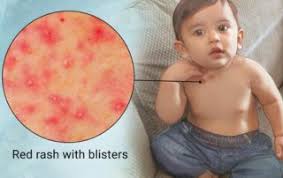 Image result for sweat rash on back baby