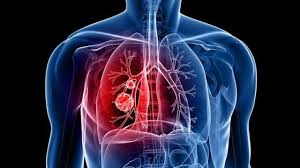 August 26, 2017 inaban 1 comment kesehatan asbes, asbestos, carsinogenic, chrysotile, crocidolite, karsinogen. Bahaya Asbes Bagi Kesehatan Keluarga Kumparan Com