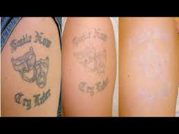 It helps in removal of acne scars, age spots, and deadly skin blemishes. The Cheapest Tattoo Removal You Do It Yourself At Home Youtube