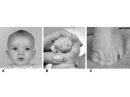 Check spelling or type a new query. Greig Cephalopolysyndactyly Syndrome Gcps