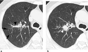The photo of the object together with the surrounding body part is down there, thow it's not too pleasant to look at. Tree In Bud Pattern In Central Lung Cancer Ct Findings And Pathologic Correlation Lung Cancer