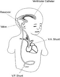 Diagnostic Modalities To Determine Ventriculoperitoneal Shunt Malfunction A Systematic Review And Meta Analysis The American Journal Of Emergency Medicine