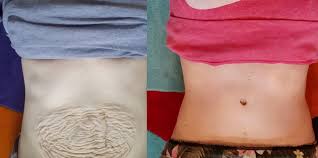 If you have not had a bowel movement after a couple. Tummy Tuck After Pregnancy Tummy Tuck Beverly Hills