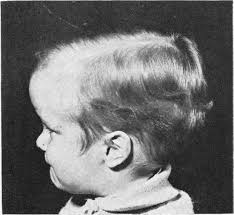 Incidence andTreatment ofPost-meningitic Hydrocephalus in the Newborn