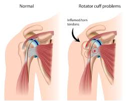 Call it what you want, shoulder injury, repetitive strain injury, rotator cuff tendonitis or rotator cuff injury, if there's no significant rip or tear. Rotator Cuff Injury Shoulder Specialist Santa Barbara Santa Maria Ventura Ca