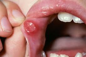 Canker sores (aphthous ulcers) appear as small, painful swellings on the lips or inside the mouth. Recurrent Aphthous Stomatitis Mouth And Dental Disorders Merck Manuals Consumer Version