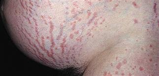 Image result for pruritic urticarial papules and plaques of pregnancy