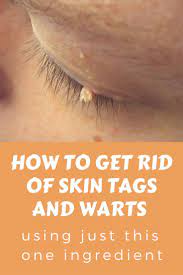 How To Get Rid Of Skin Tags And Warts Using Just This One Ingredient Have You Ever Tried This Diy Skin Tag Removal Skin Tags Home Remedies Skin Tags On Face