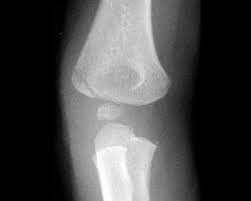 Image result for Lateral Condyle Fracture