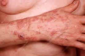 Image result for syphilis ulcer