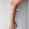 Tennis elbow, or lateral epicondylitis, is a painful condition of the elbow caused by overuse. 1