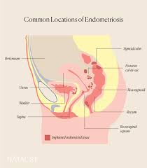 Scar tissue and adhesions form as a result, which can lead to anatomical changes. Endometriosis And Its Effect On Fertility And Pregnancy