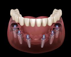 All-On-6 dental implants : technique, procedure and price | Body Expert
