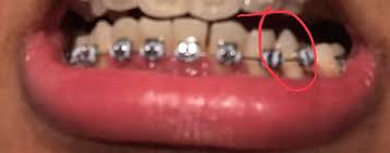 You can use either a cotton swab or your finger to apply it. Is Extreme Pain In This Tooth Normal Braces