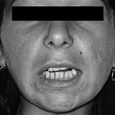 CT imaging around the hip showing marked gluteus muscle atrophy.