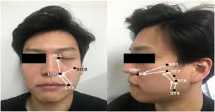 It occurs most often in pregnant women, and in people who have diabetes, influenza, a cold, or another upper respiratory ailment. Clinical Effectiveness Of Thread Embedding Acupuncture In The Treatment Of Bell S Palsy Sequelae A Randomized Patient Assessor Blinded Controlled Clinical Trial Sciencedirect
