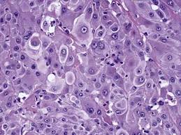 Is mesothelioma linked to esophageal cancer? Epithelioid Malignant Mesothelioma Thoracic Pathology A Volume In The High Yield Pathology Series Expert Consult Online And Print 1st Edition