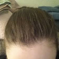 A., bowen j., kealey t. Does Overall Health And Medications Affect Prp Or Other Hair Loss Treatment Results Photo