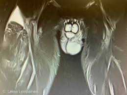 Rectus Femoris Injury Information Urheiluortopedi Lasse Lempainen