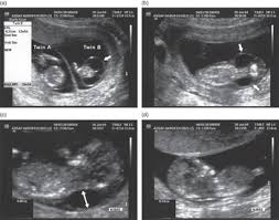 Dating ultrasound scans, also known as early ultrasounds, are typically the first type of obstetric evaluation during pregnancy. Prenatal Diagnosis After Assisted Reproductive Technology Chapter 13 Pregnancy After Assisted Reproductive Technology