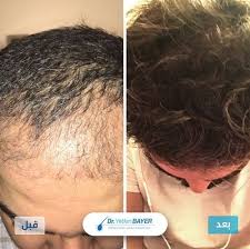 pin by yetkin bayer clinic on قبل وبعد زراعة الشعر incoming call screenshot