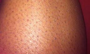 The black nodules were asymptomatic, but the patient noted that they seemed to be moving up the hair shaft. Pin On Tmac