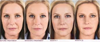 See patient results, explore case details, find examples of the results you'd like to see. Sculptra Aesthetic Derma Fountain Of Youth Derma Fountain Of Youth