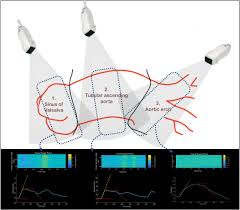Frontiers | Methods: Aortic wall deformation assessment by ultrafast  ultrasound imaging: Application to bicuspid aortic valve associated  aortopathy