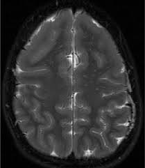 Lissencephaly is a rare disorder in which a baby's brain doesn't develop folds or grooves. Lissencephaly Mr Imaging T2 Fse Axial Plane Shows A Smooth Brain Download Scientific Diagram