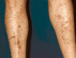How a fungus takes hold. Diabetes Dark Spots Skin Diabetes Dark Spots