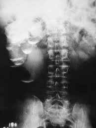 Final Diagnosis Renal Milk Of Calcium Cyst Abdomen