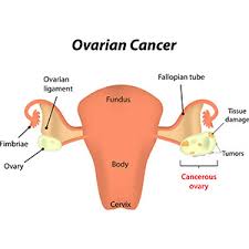 Get checked out if your symptoms national ovarian cancer coalition: Ovarian Cancer Diagnosis And Treatment Women S Cancer And Surgical Care P C