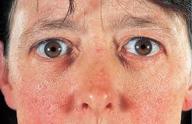 References In Graves Disease The Lancet
