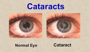 Maybe you would like to learn more about one of these? Cataract Eye Treatment Ahalia Foundation Eye Hospital