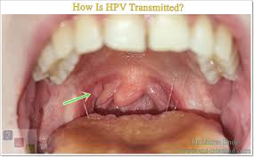 Image result for papillomavirus tongue)