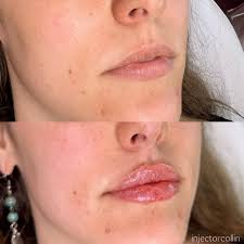 A full syringe of lip filler (1 mL ~ 1/5 tsp.) is actually not as much as  it seems or looks in the syringe. 💉 You heard it before, and I'll say