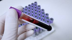 Systemic lupus erythematosus (sle) is an autoimmune disease presenting with varying degrees of organ and system involvement. ØªØ­Ù„ÙŠÙ„ Ø§Ù„Ø°Ø¦Ø¨Ø© Ø§Ù„Ø­Ù…Ø±Ø§Ø¡ Sle E3arabi Ø¥ÙŠ Ø¹Ø±Ø¨ÙŠ