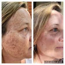 TOP 10 BEST Skin Tightening in Westminster, CO