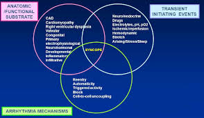 Image result for Exercise Induced Syncope