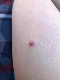 It is a benign condition, which usually appears as a small tan or sometimes pink pimple under skin. Ingrown Hair On My Leg Ah Popping