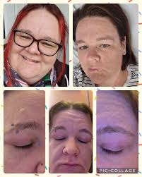 Healing beautifully One week post Upper Blepharoplasty by Mark Fernandez MD  #getMarked