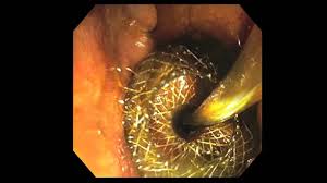 This animation provides a step by step detailed view of how to use the axios stent and electrocautery enhanced delivery. Eus Guided Tranbulbar Bile Duct Drainage With Axios Stent Hd Youtube