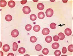 Image result for G6PD Deficiency