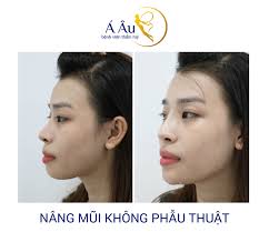 Nâng mũi bằng phương pháp tiêm