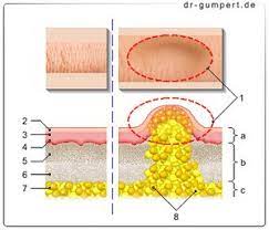 Lipom Am Kopf Wie Gefahrlich Ist Das
