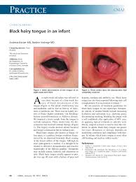 Image result for black hairy tongue symptoms
